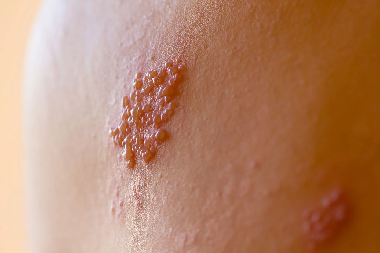 Image of shingles on skin